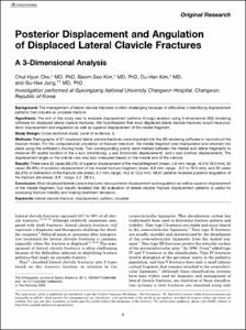 Posterior Displacement and Angulation of Displaced Lateral Clavicle Fractures: A 3-Dimensional Analysis