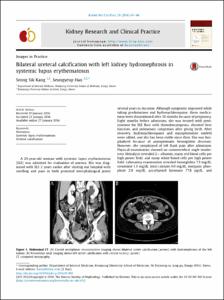 Bilateral ureteral calcification with left kidney hydronephrosis in systemic lupus erythematosus