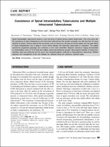 Coexistence of Spinal Intramedullary Tuberculoma and Multiple
Intracranial Tuberculomas