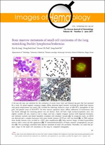 Bone marrow metastasis of small cell carcinoma of the lung mimicking Burkitt lymphoma/leukemias