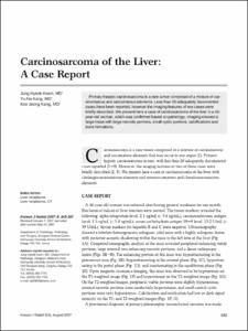 Carcinosarcoma of the Liver: A Case Report