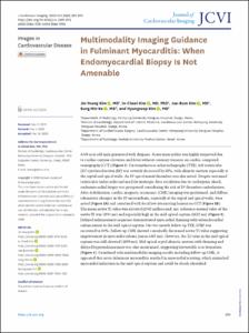 Multimodality Imaging Guidance in Fulminant Myocarditis: When Endomyocardial Biopsy Is Not Amenable