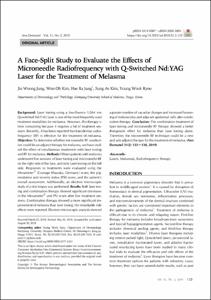 A Face-Split Study to Evaluate the Effects of Microneedle Radiofrequency with Q-Switched Nd:YAG Laser for the Treatment of Melasma