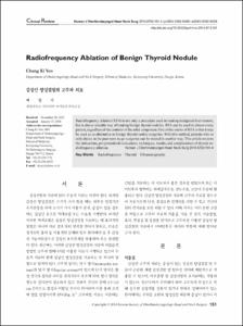 Radiofrequency Ablation of Benign Thyroid Nodule