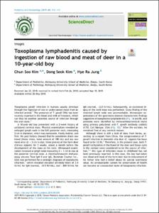 Toxoplasma lymphadenitis caused by ingestion of raw blood and meat of deer in a 10-year-old boy