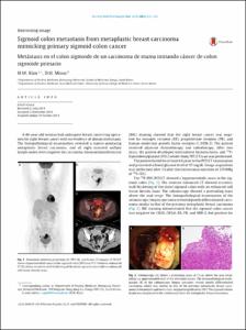 Sigmoid colon metastasis from metaplastic breast carcinoma mimicking primary sigmoid colon cancer
