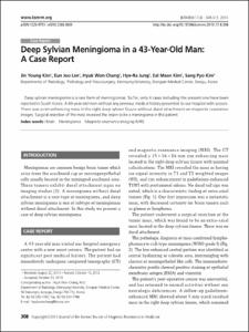 Deep Sylvian Meningioma in a 43-Year-Old Man: A Case Report