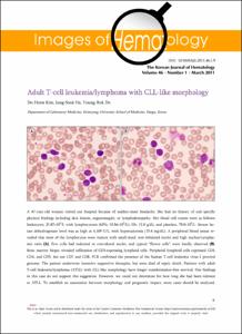 Adult T-cell leukemia/lymphoma with CLL-like morphology