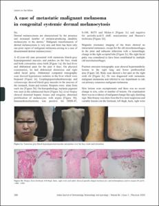 A case of metastatic malignant melanoma in congenital systemic dermal melanocytosis